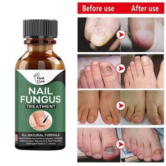 Glamstor| Nail Fungus Treatment Stop Fungal Growth Effective Fingernail 10ml